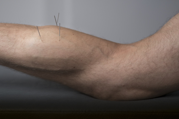 Dry Needling Therapy